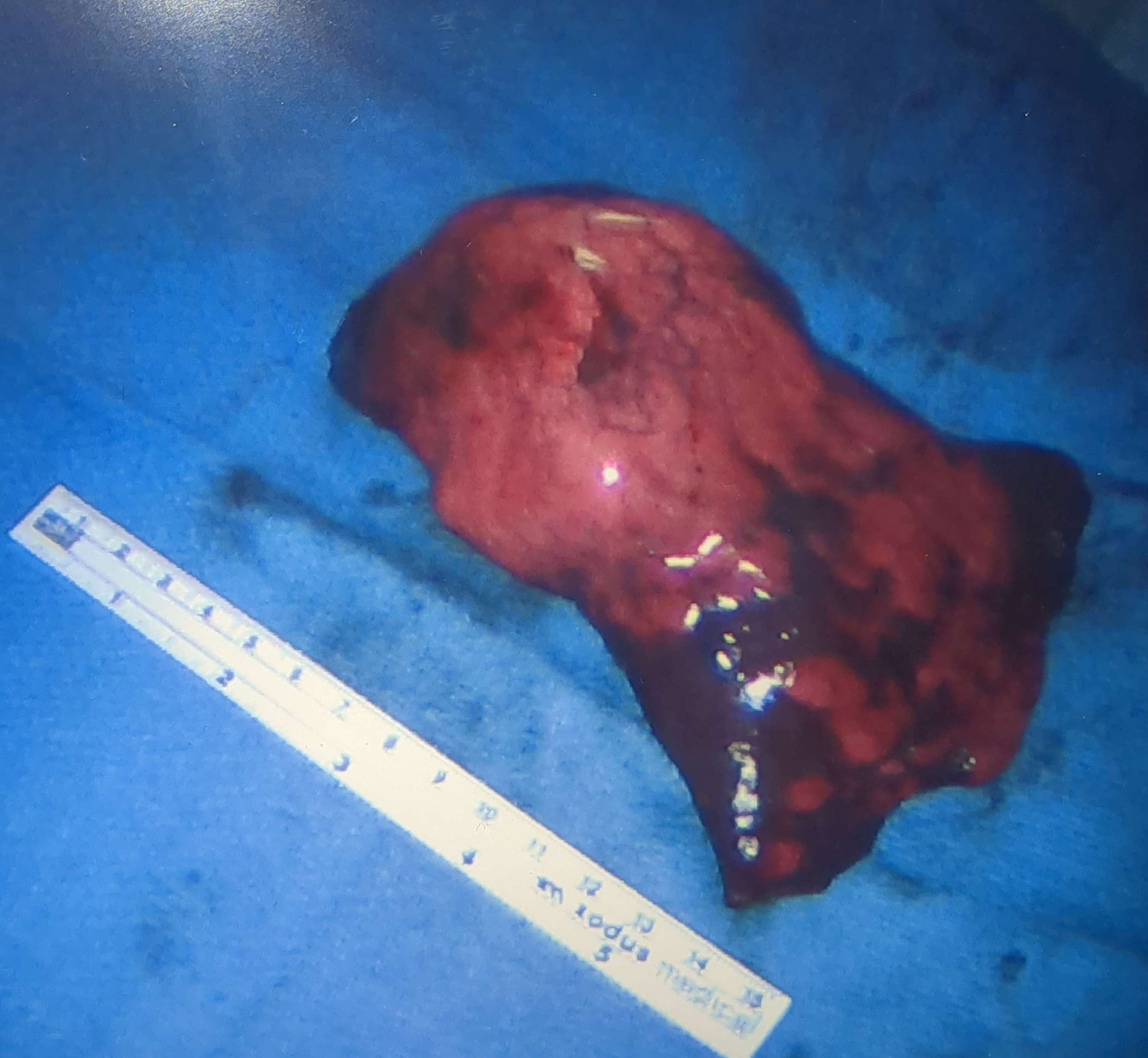 Osteosarcoma metastasis removed from the left lung, shown as a medical specimen on a blue surgical drape with a ruler.