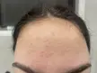 How do I get rid of these small pimples on my forehead?