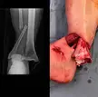Severe open fracture of the tibia in a football player