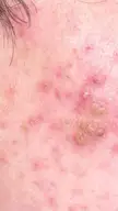 What are these scabs from acne. Before it was cystic acne now they are brown hard scabs?