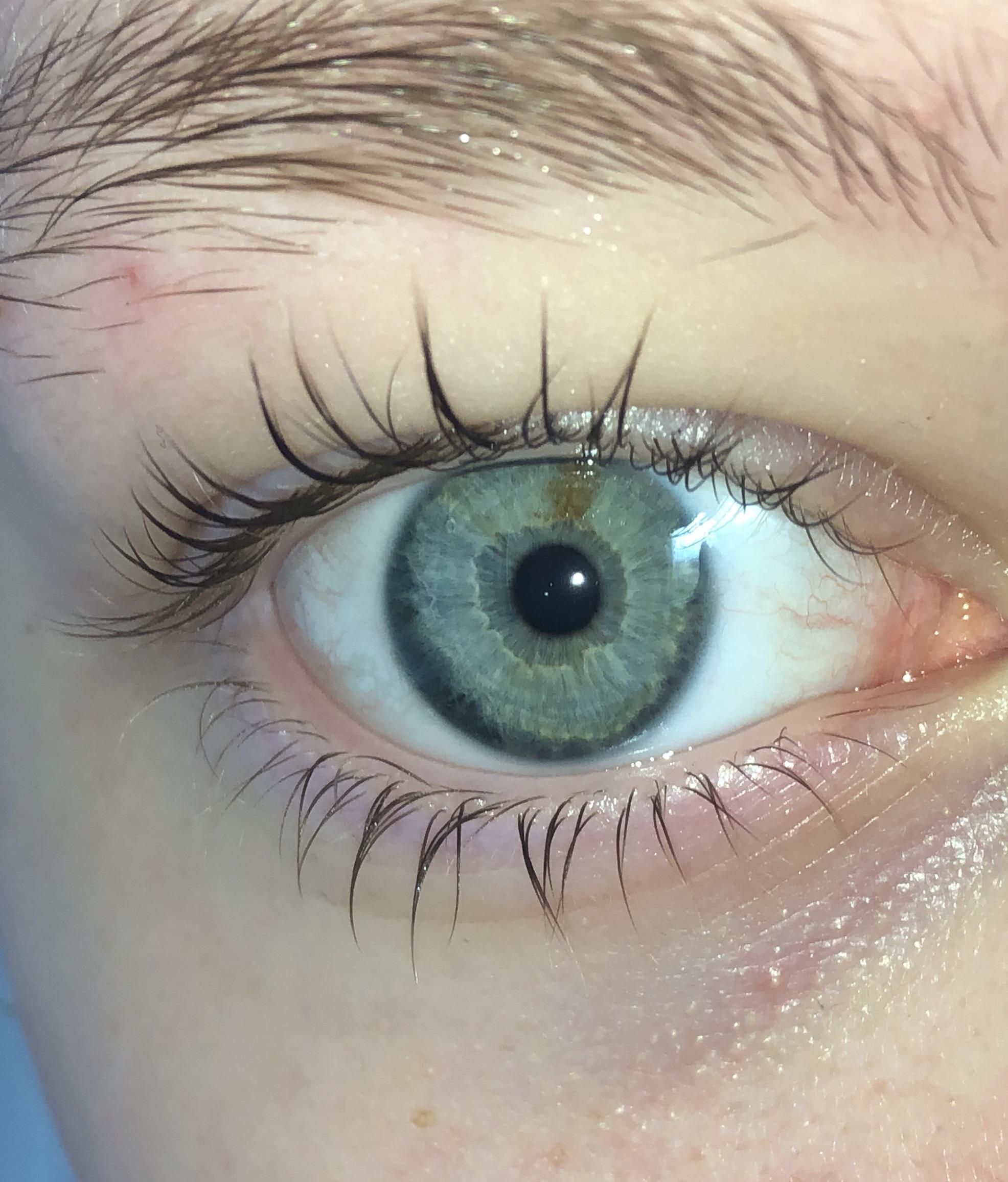 discover-more-like-eyes-i-have-got-this-brown-spot-in-my-eye-what-s