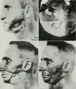 Radium jaw