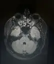 My MRI looks like a demon