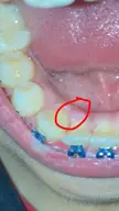 hi, i just got this little gum bump behind my teeth , should I be worried ? would it go away on its own ?