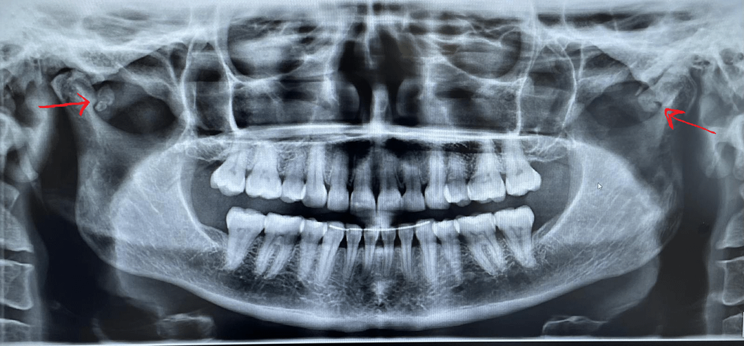 xrays