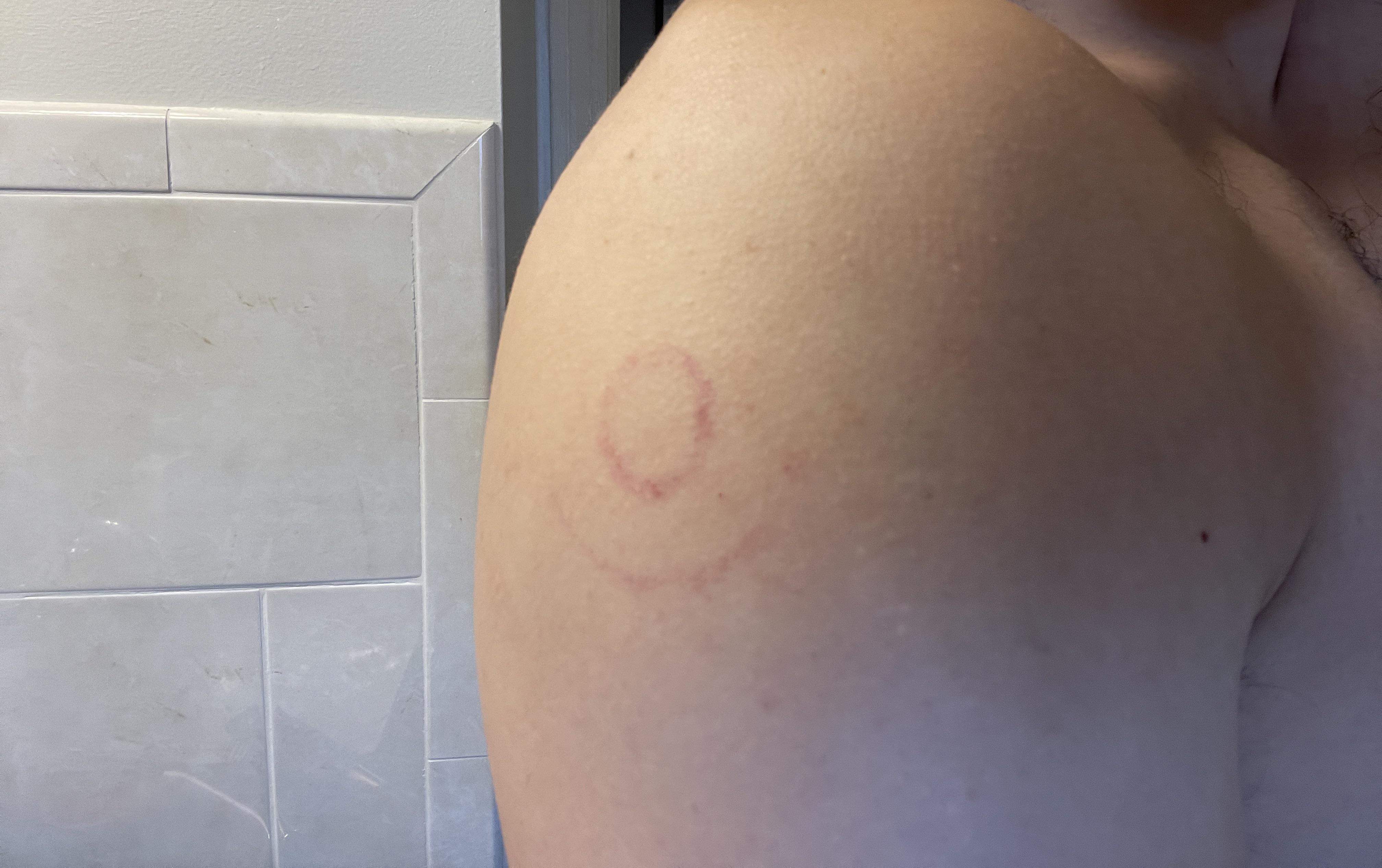 Perfect circle rash on my arm | Scrolller