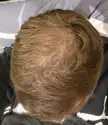 Hairloss