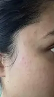Tiny red itchy bumps on my face 😭 HELP!!!