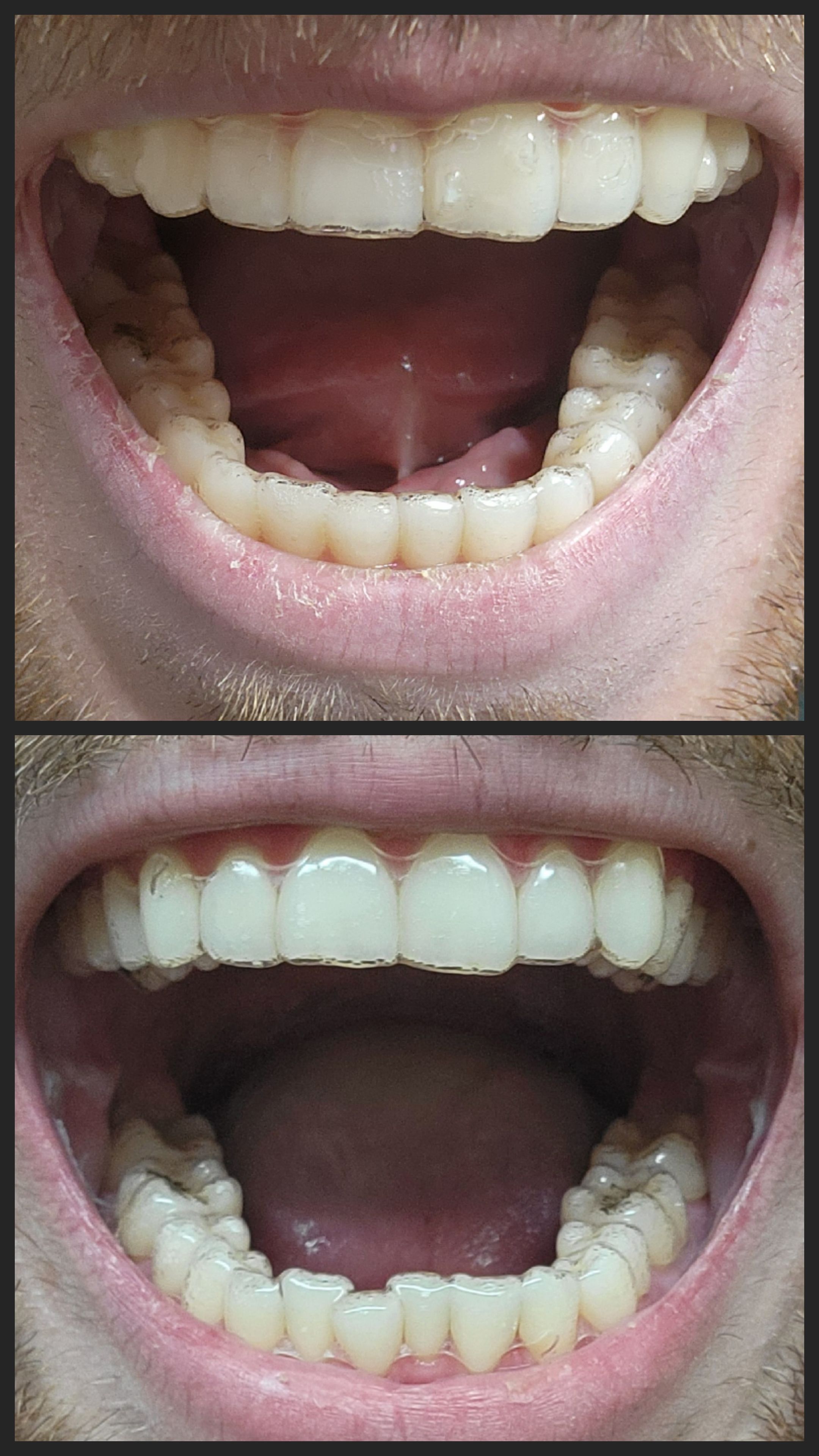 I've always hated my bottom front teeth. Now starting 1st round of ...