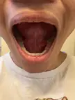 spikes protruding from underneath my tongue, is it something to worry about?
