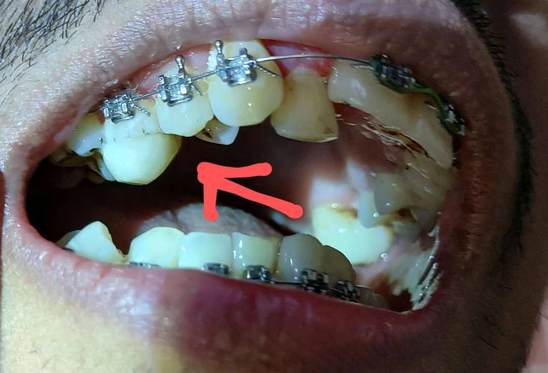 My Orthodontist installed the lower brace with bite blocks in the upper ...