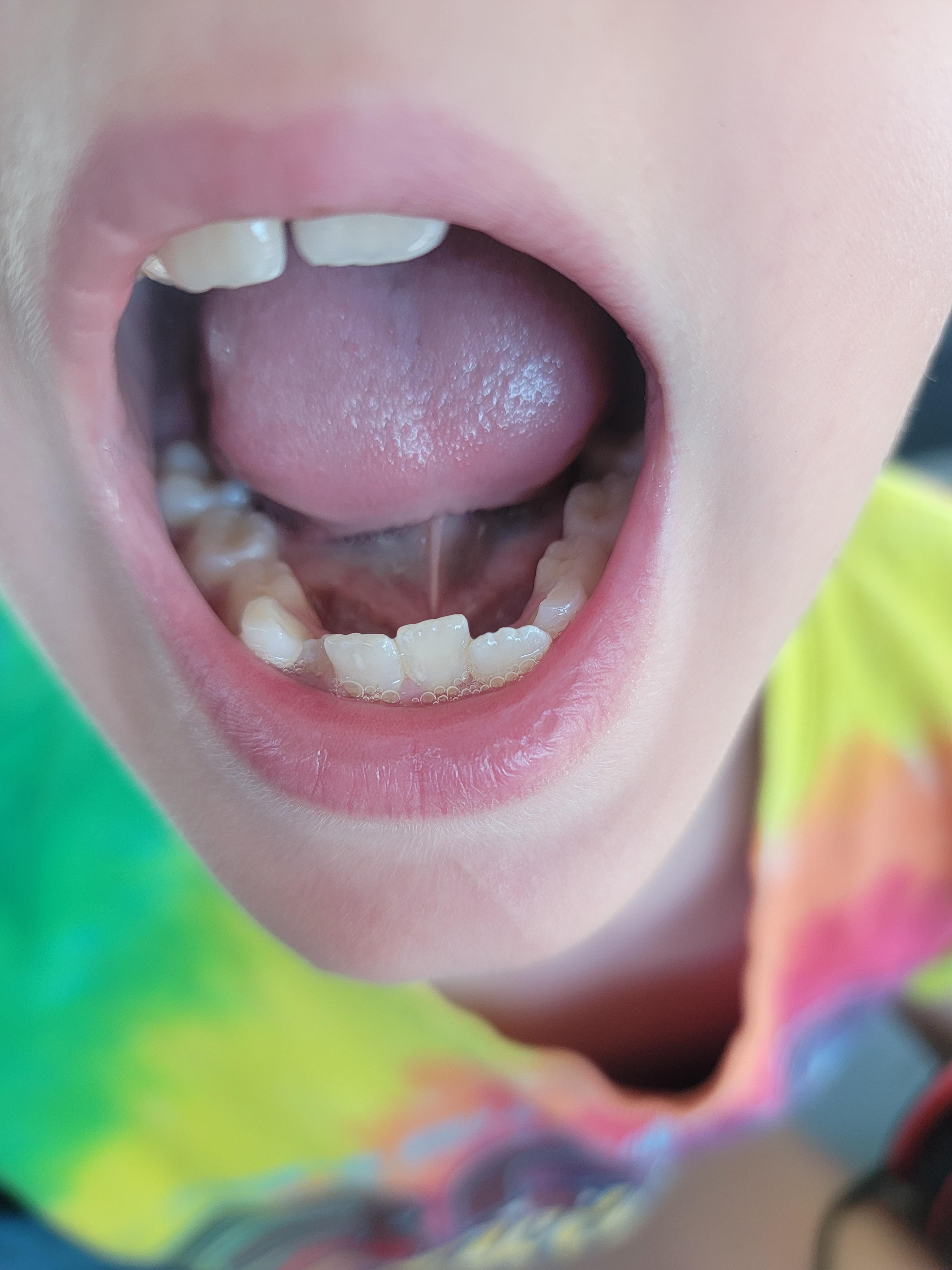Close-up of a person with pale skin wearing a tie-dye shirt, showing their mouth and teeth.