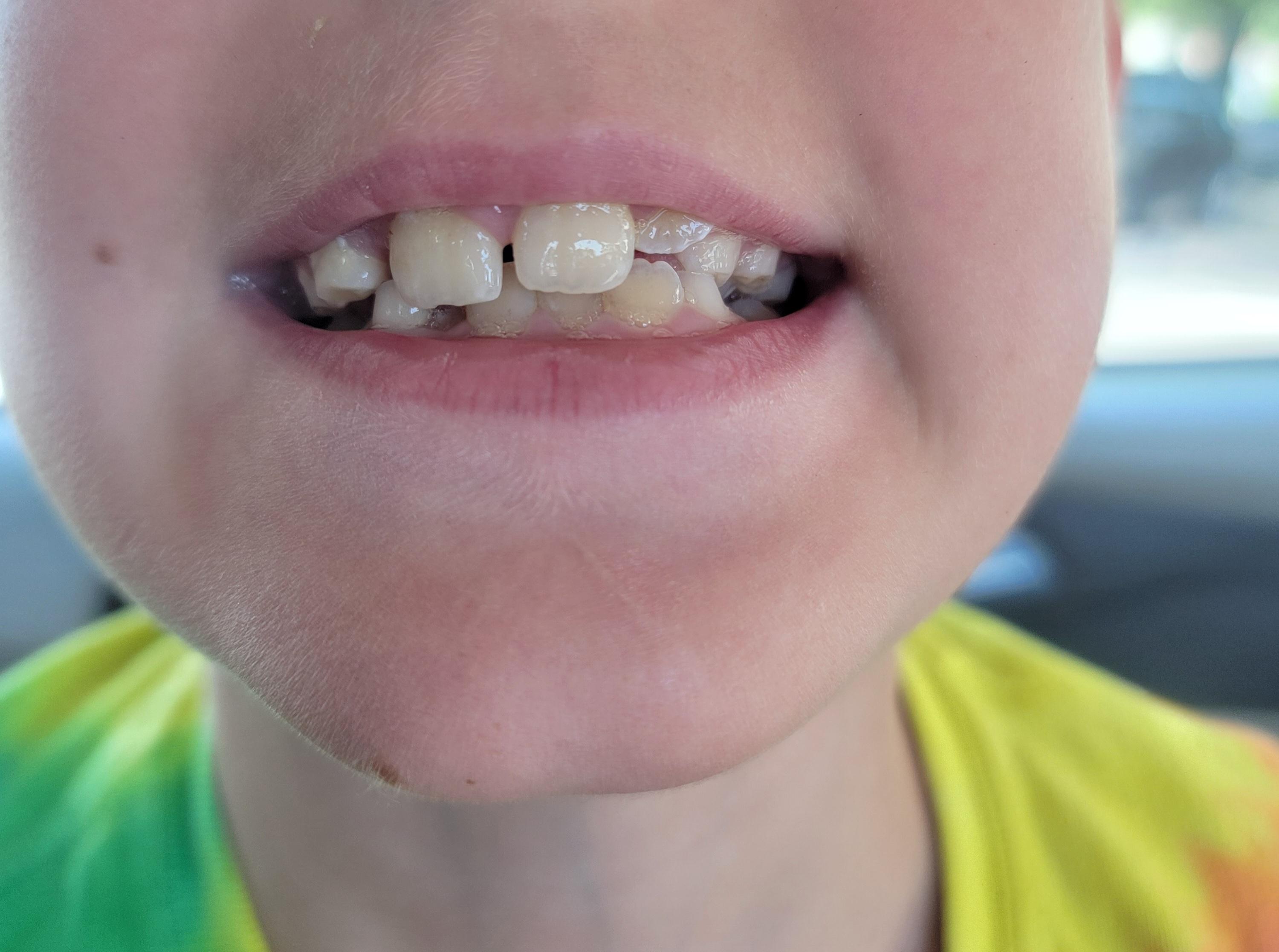 How much are we looking at costwise do you think to fix my sons teeth?