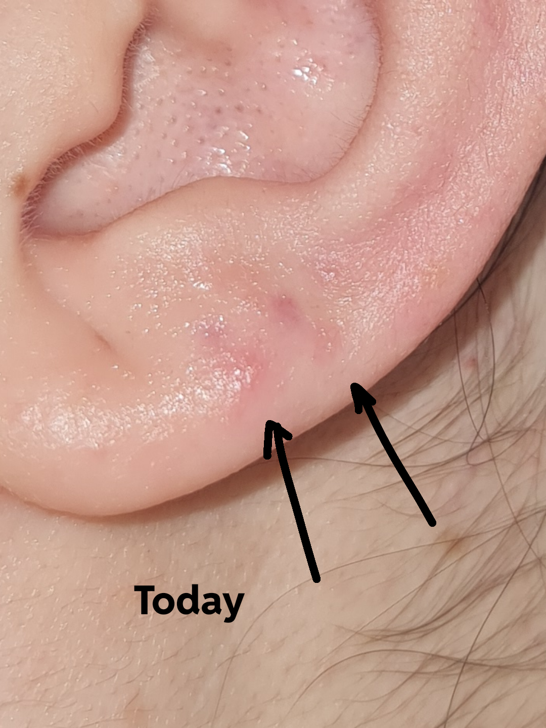 Pimple like bumps have appeared next to my old lobe piercing sites ...