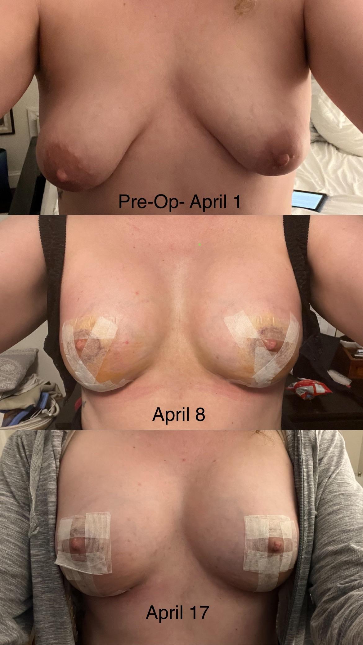 Blonde woman with a ribcage tattoo showing tuberous breast correction and breast lift recovery progress selfies