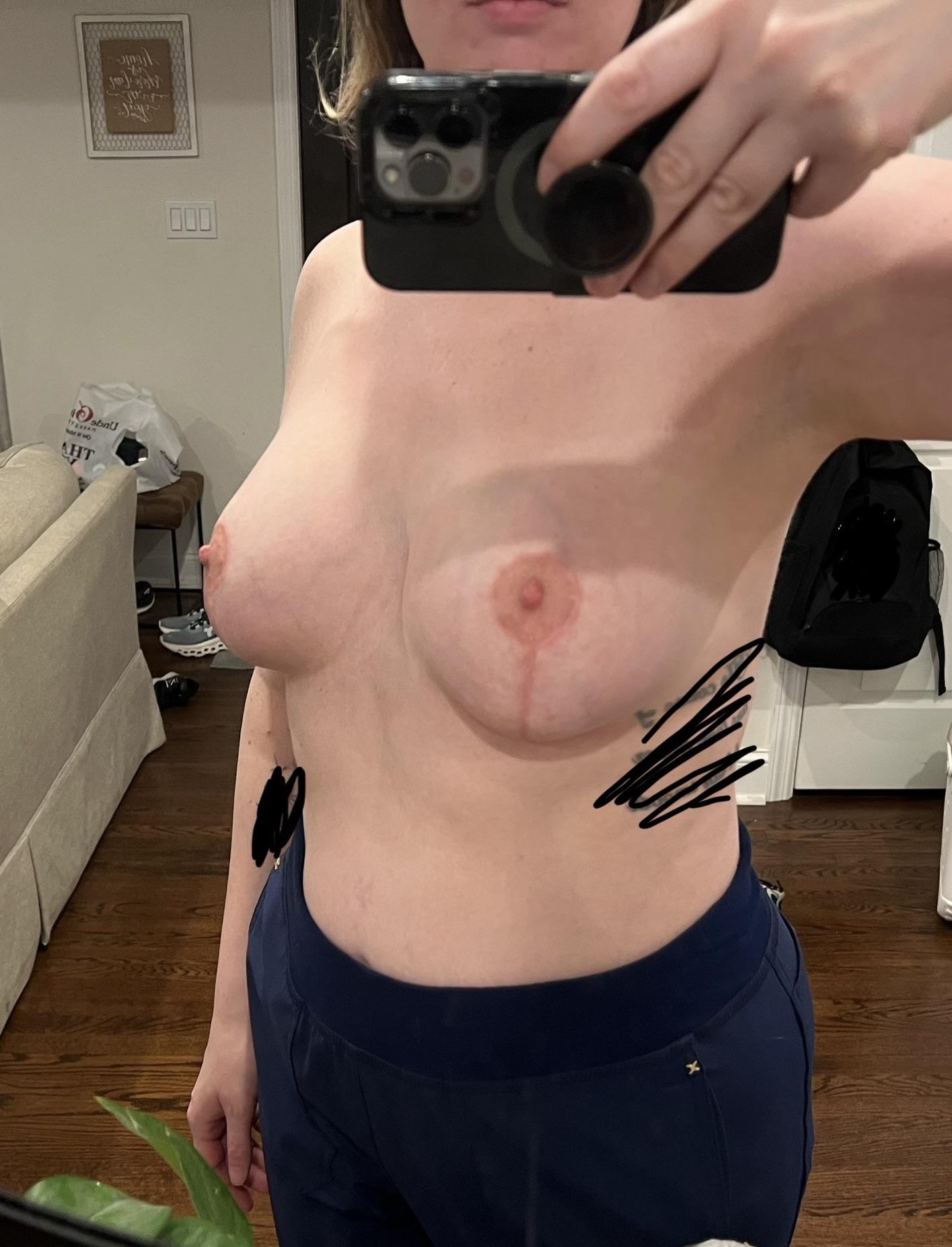 5 month update after tuberous breast correction/breast lift