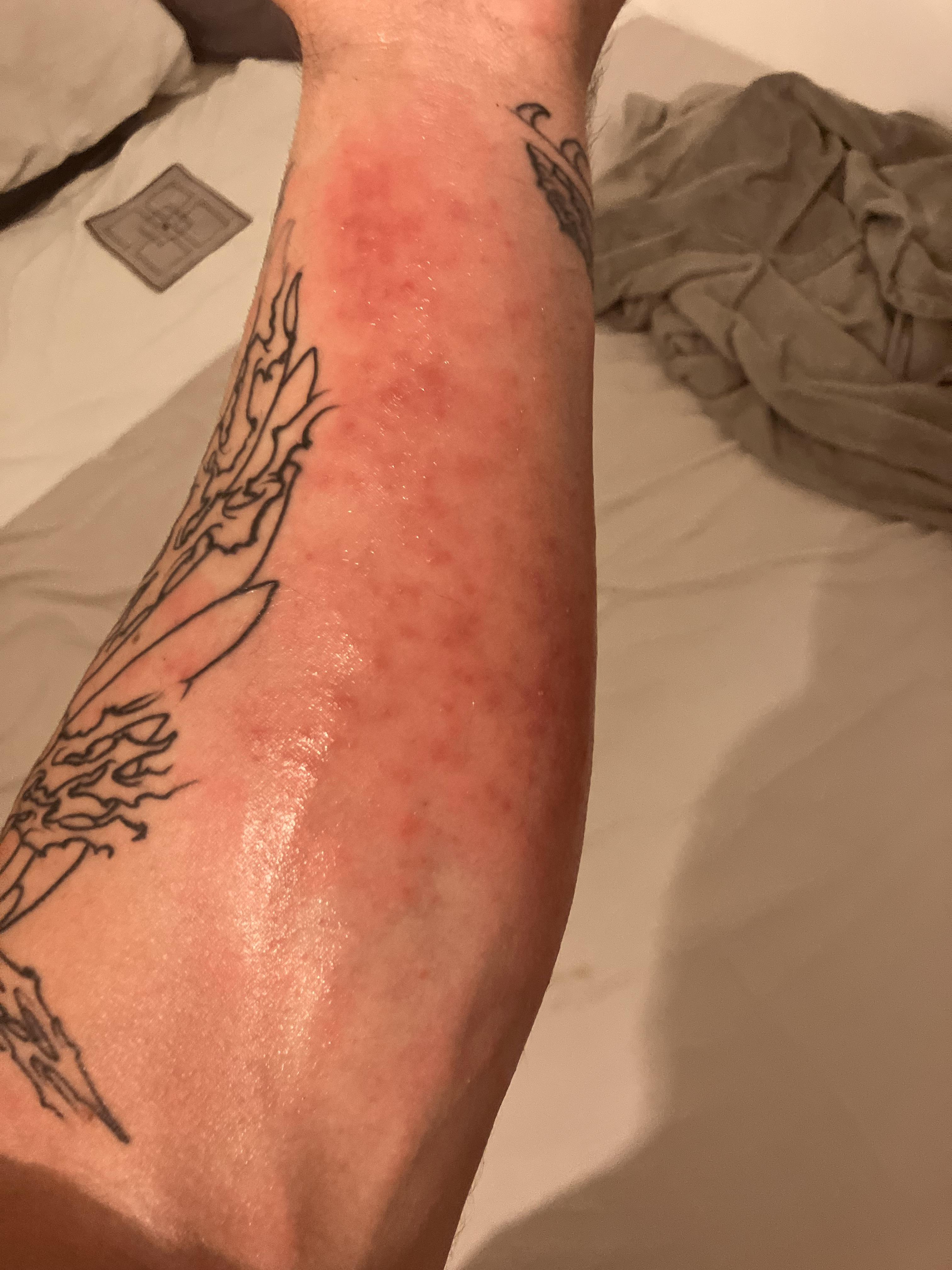 Tattoos Causing Rash Woke up to a rash around my new tattoo. Pretty sure it was caused by ...