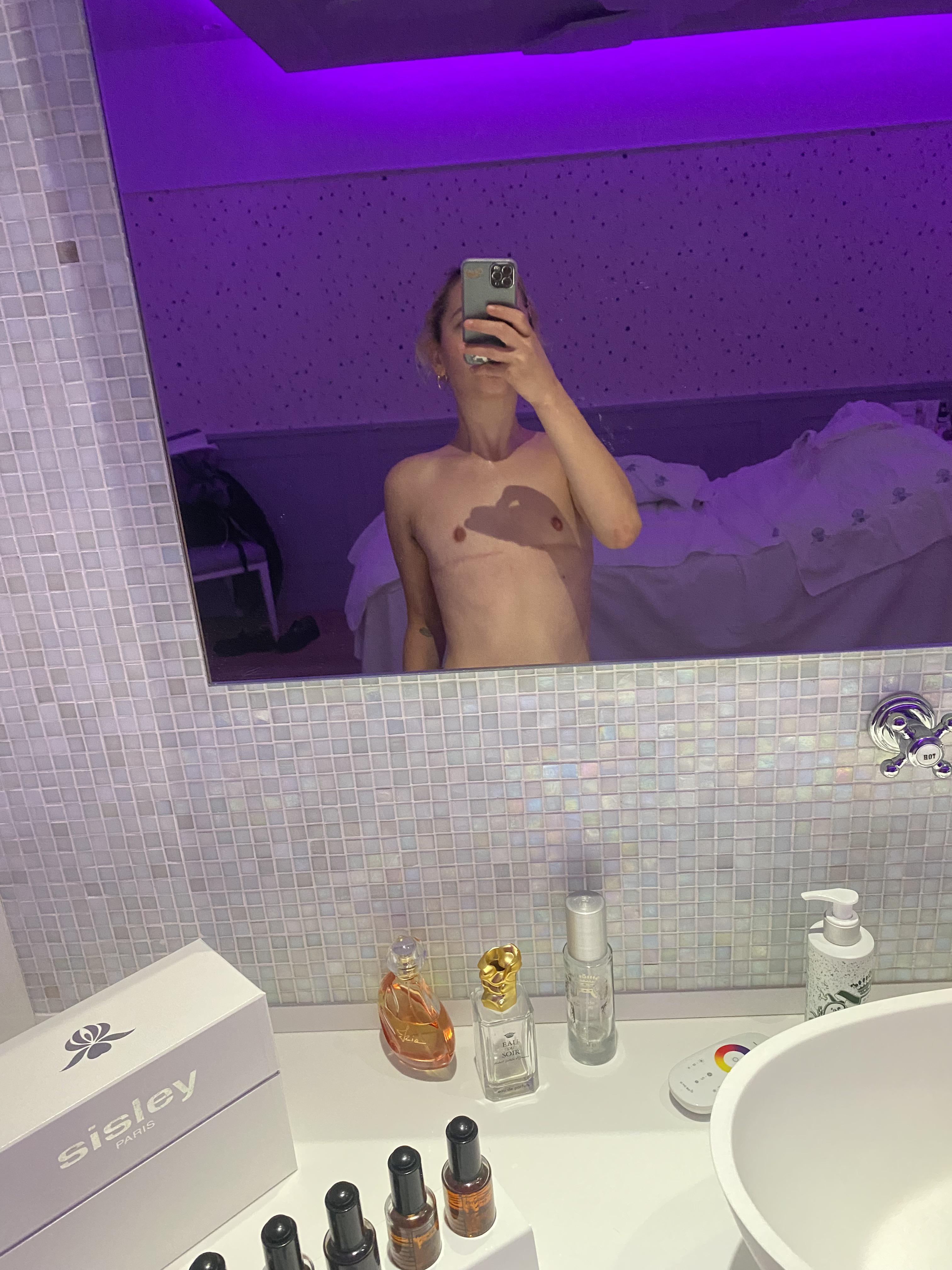 6 months post top surgery with Dr.Mosser