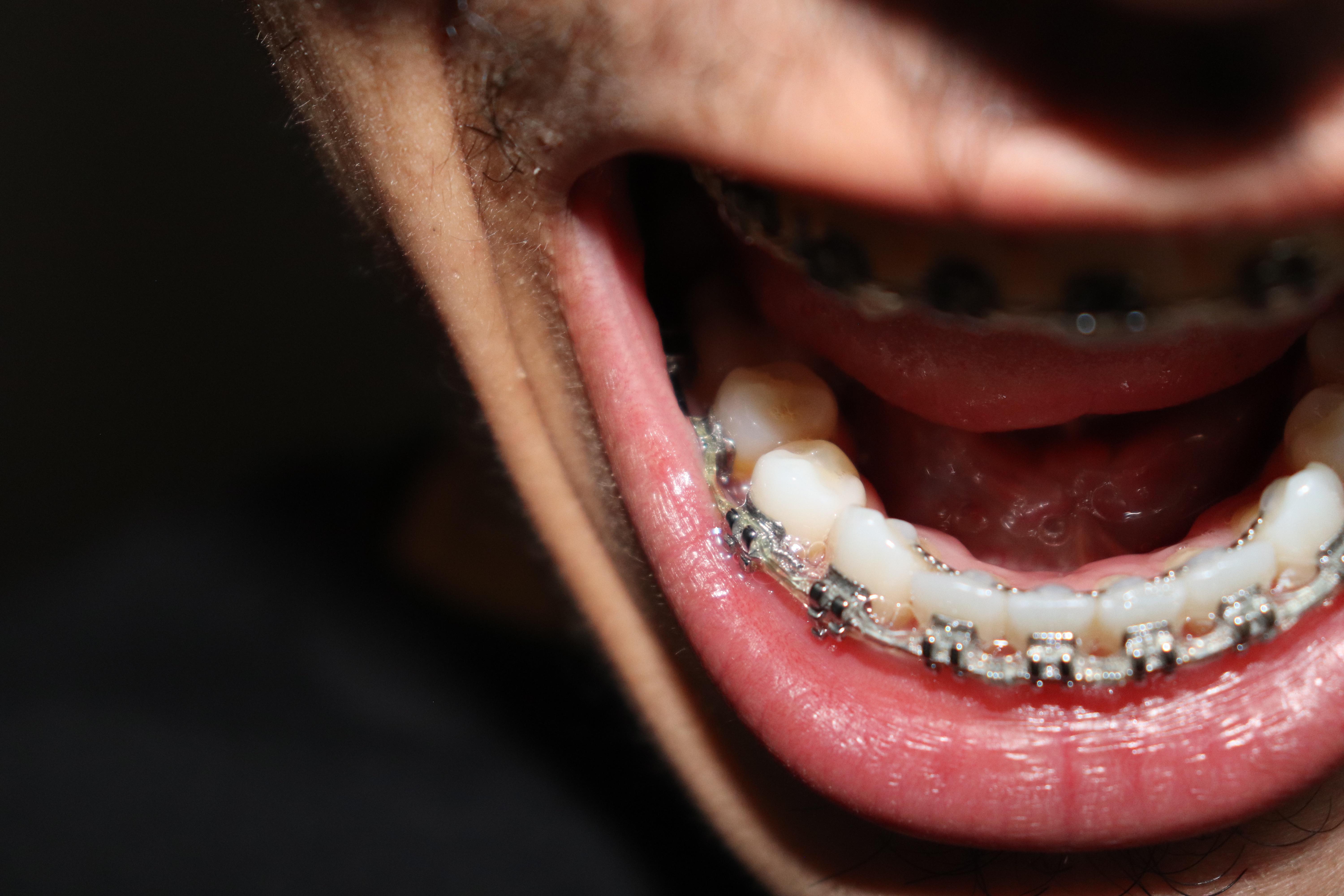 17th change & 2 years update. Supposed to take them off but 1 tooth ...
