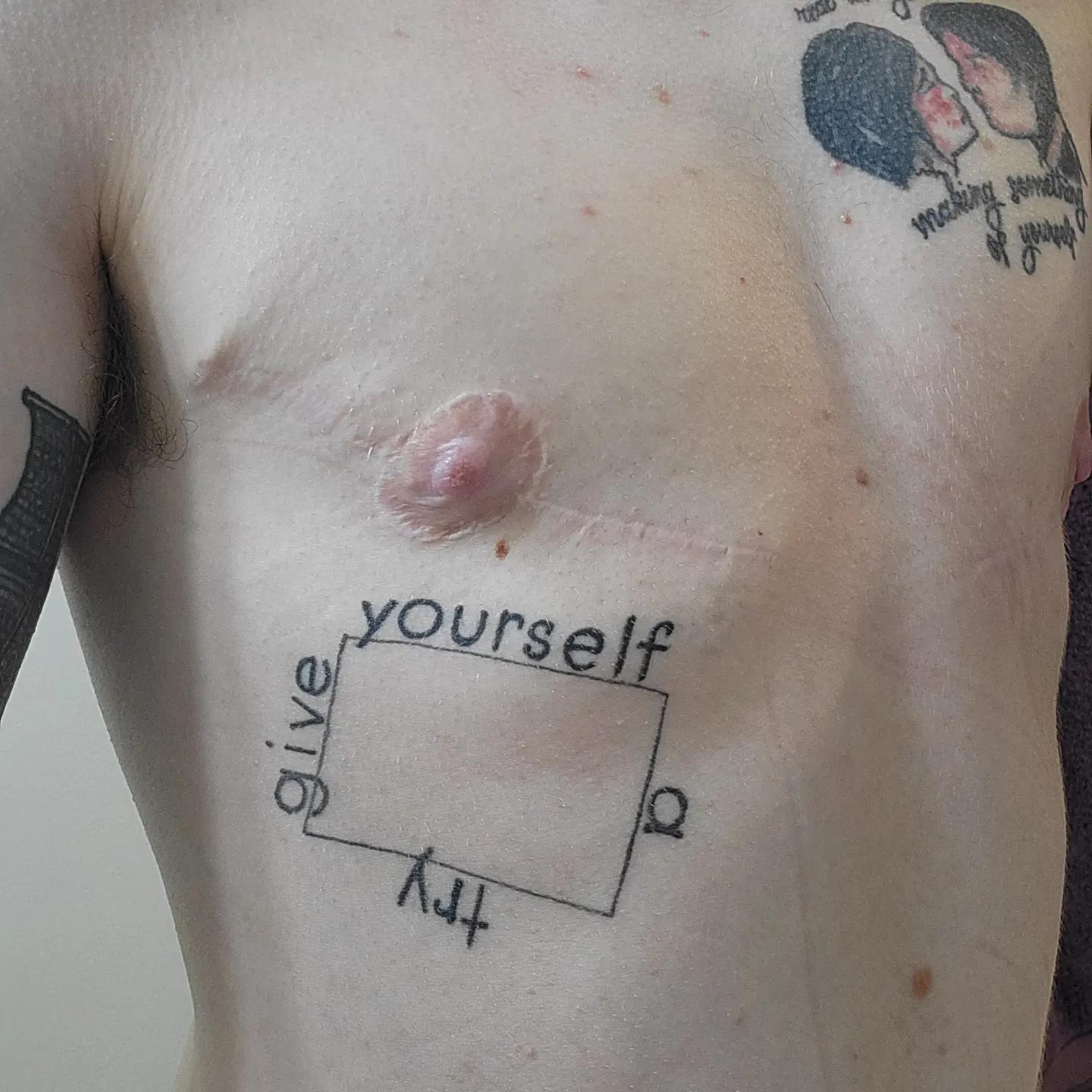 2 years post-op with Dr. Melissa Johnson in MA!