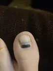 An update on my ingrown toenail after removal, A log was also dropped on it.