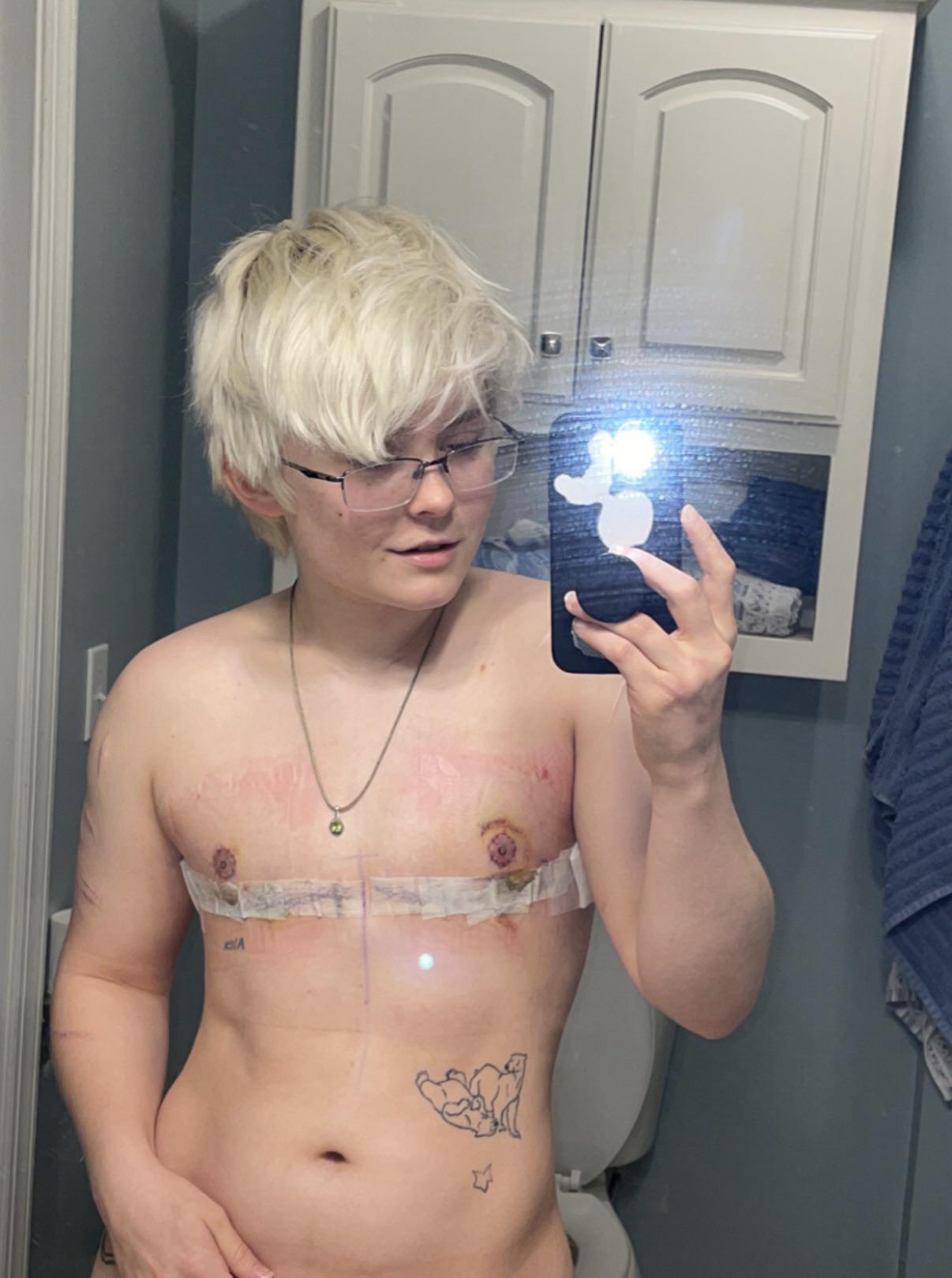 nipple reveal! one week post op :)