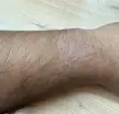 Rash on wrist