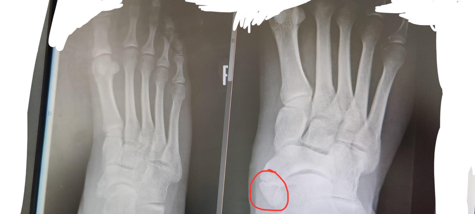 Extra bone I had in my foot (right image is preop, extra bone is circled, left image is post op with the bone removed and a screw in my foot)