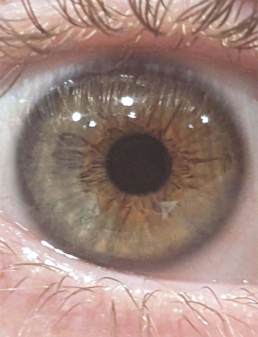 The way my iris is formed gives it two noticable ovals next to my pupils