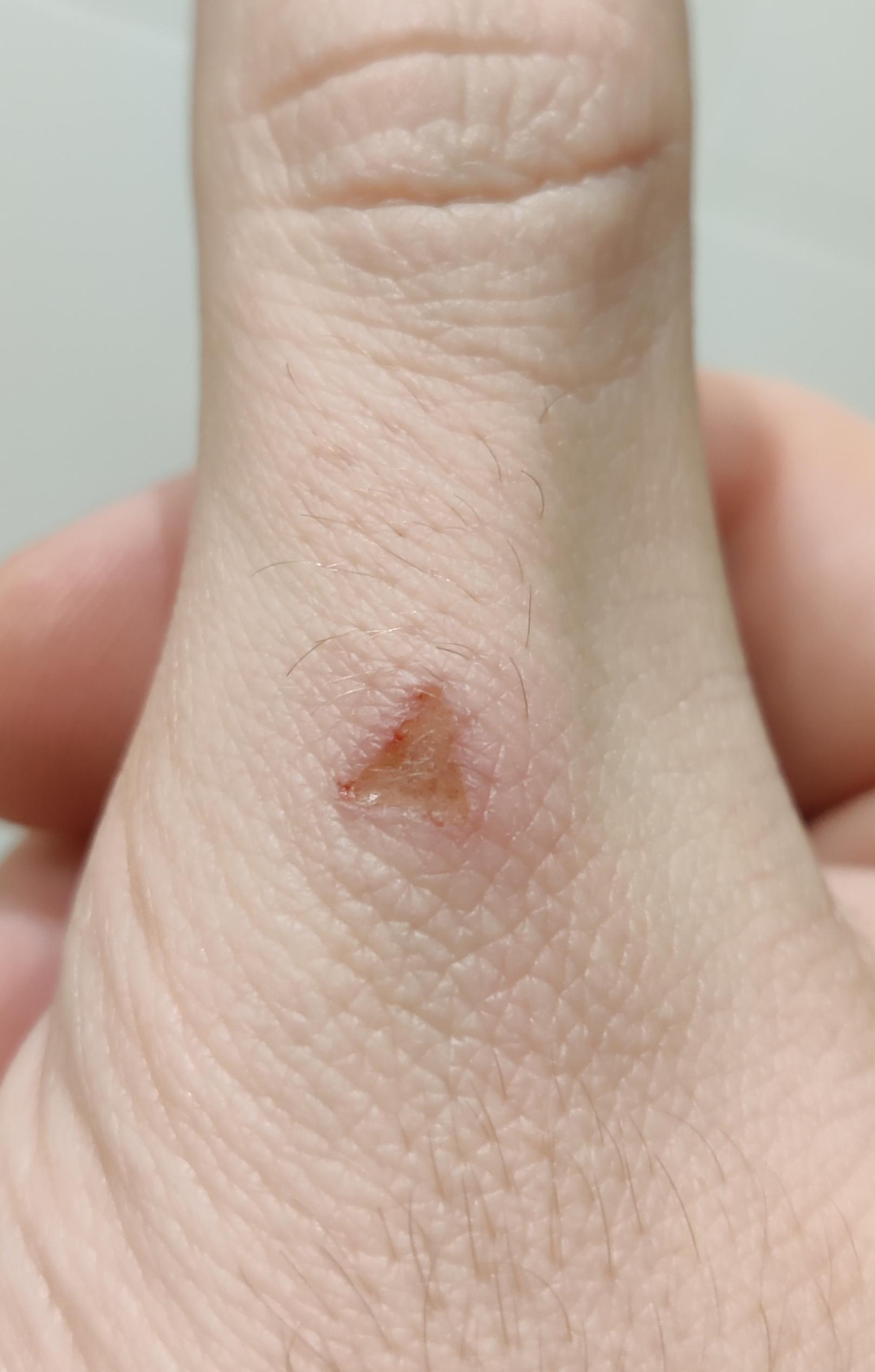 A scrape on my finger is a perfect equilateral triangle | Scrolller