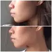 Bimaxillary Protrusion side profile update after 10 months
