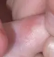 Close-up of a small red bump and holes on the side of a toe with pale skin