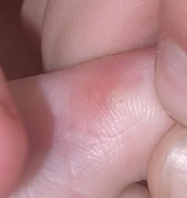 Random holes on the side of my toes