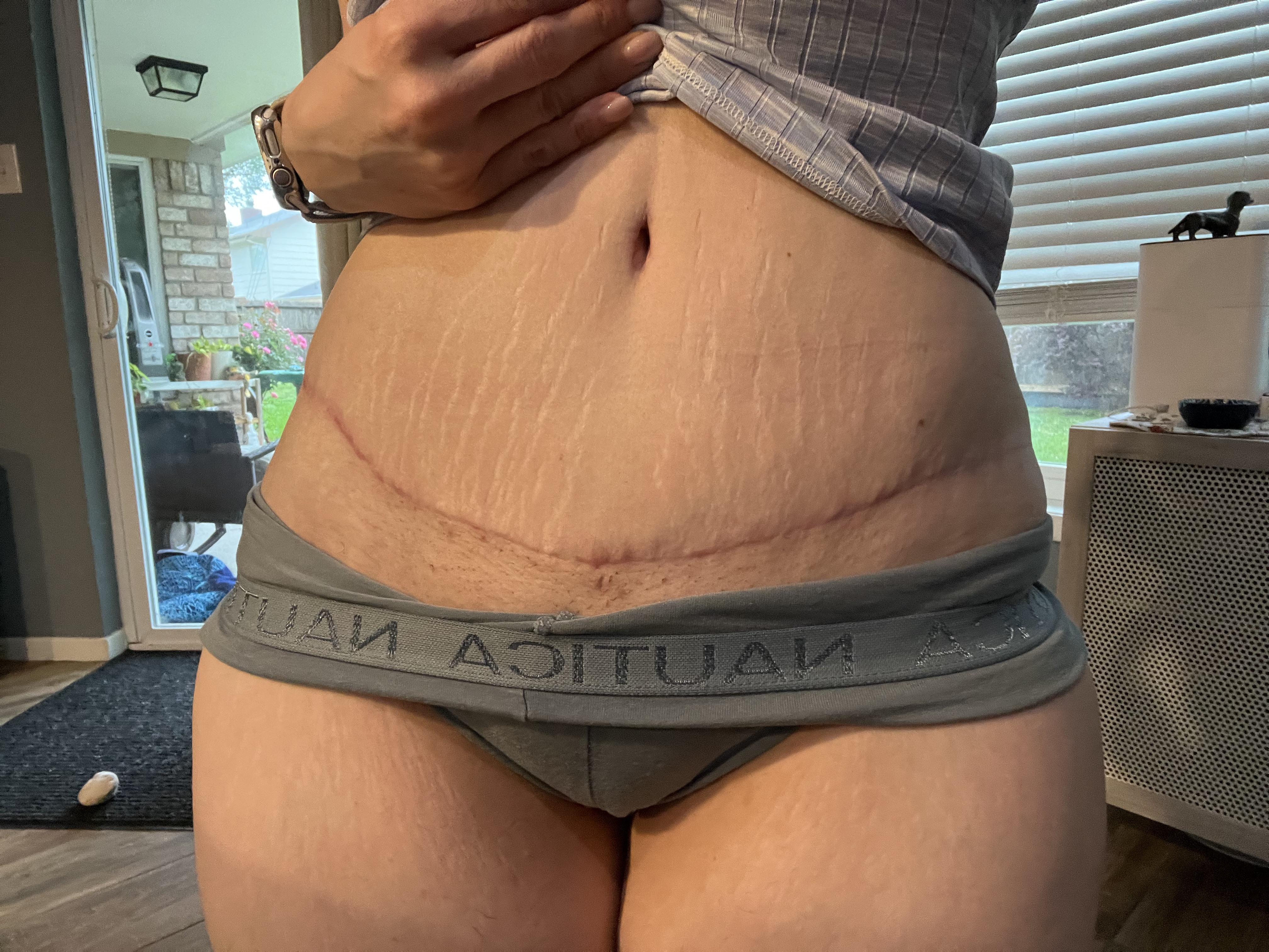 Busty white woman with a curvy mom bod showing plastic surgery progress, surgical scars, and breast markings.