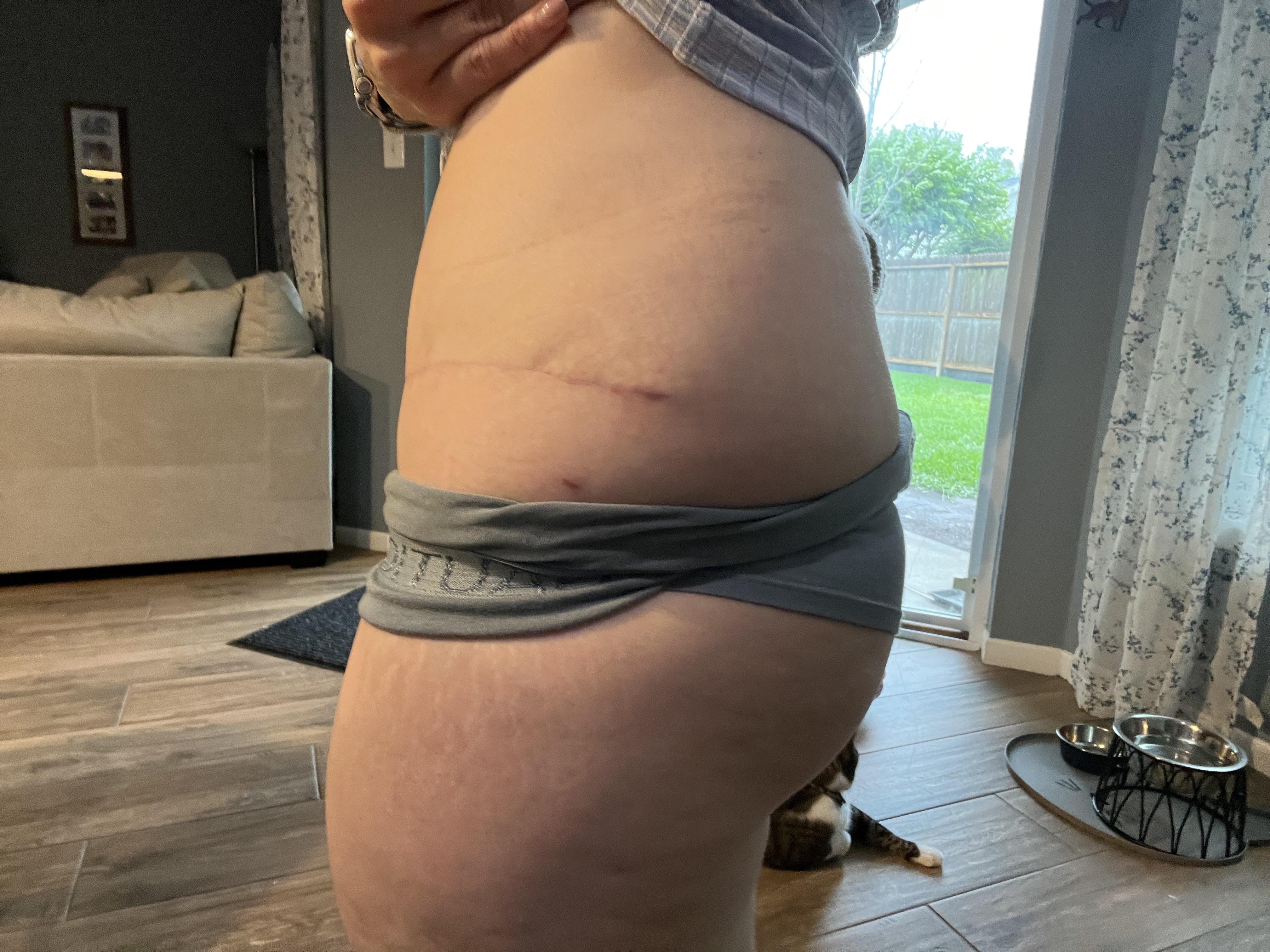 Busty white woman with a curvy mom bod showing plastic surgery progress, surgical scars, and breast markings.