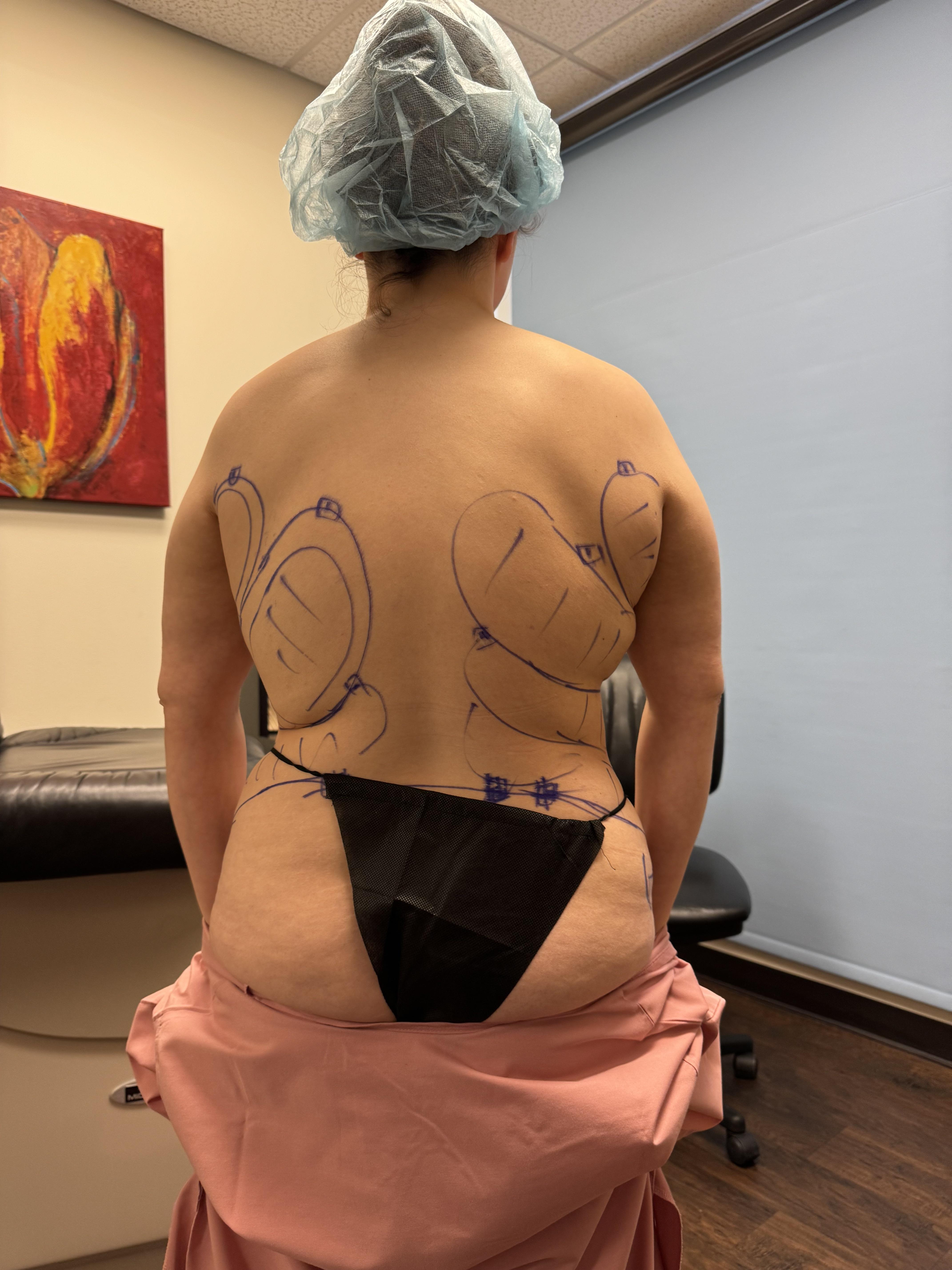 Busty white woman with a curvy mom bod showing plastic surgery progress, surgical scars, and breast markings.