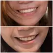Bimaxillary Protrusion, before and after braces