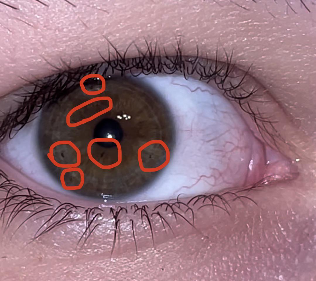 What are the names of these specks in my eyes, and why do they happen?