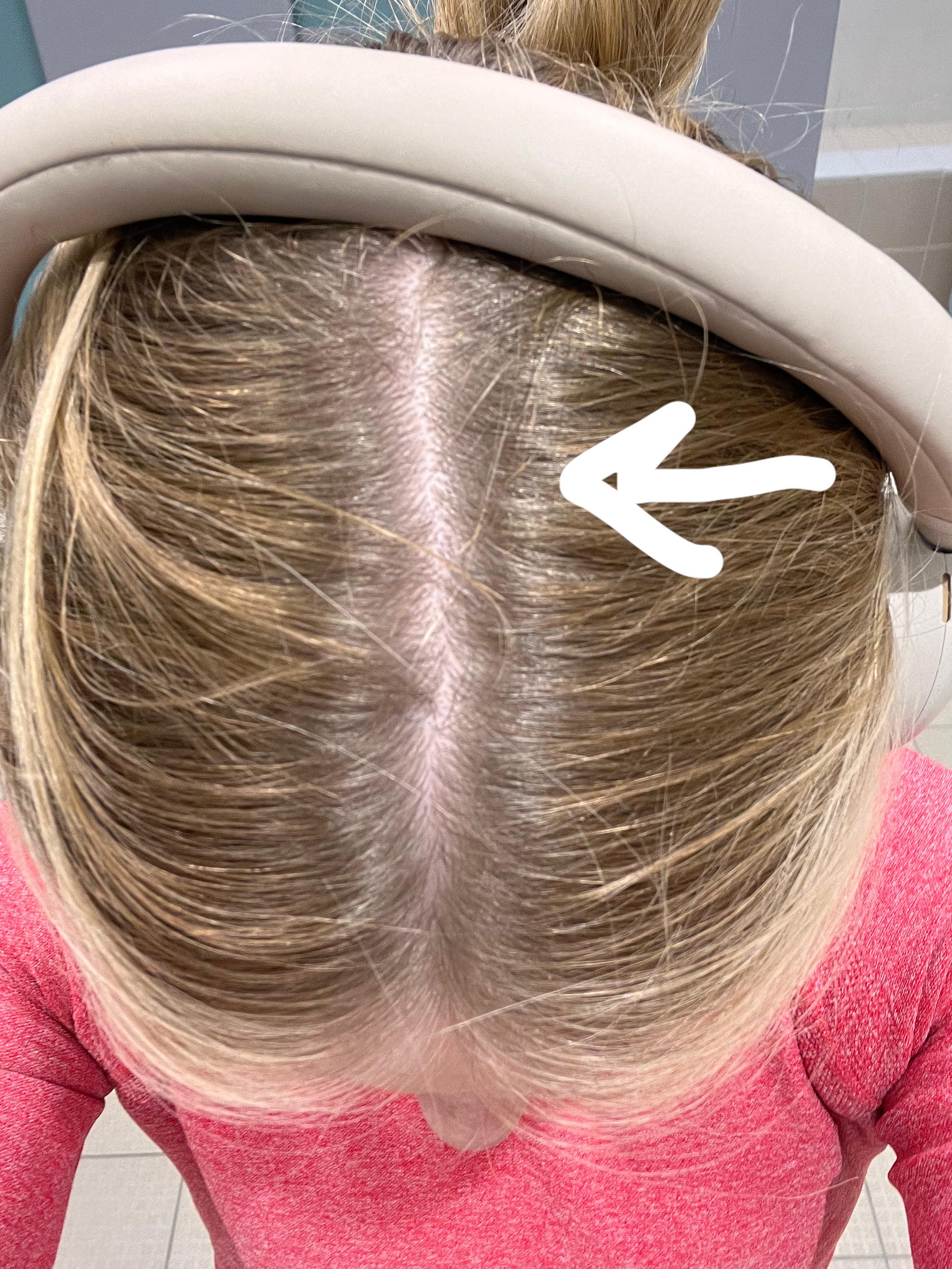 Is my root drag needing fixed? I got a root drag/ melt from hairdresser ...