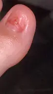 Is my toenail removal healing well?