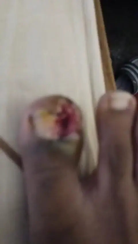 Is this matrixectomy done correctly? Is this how the nail looks after a week of matrixectomy 