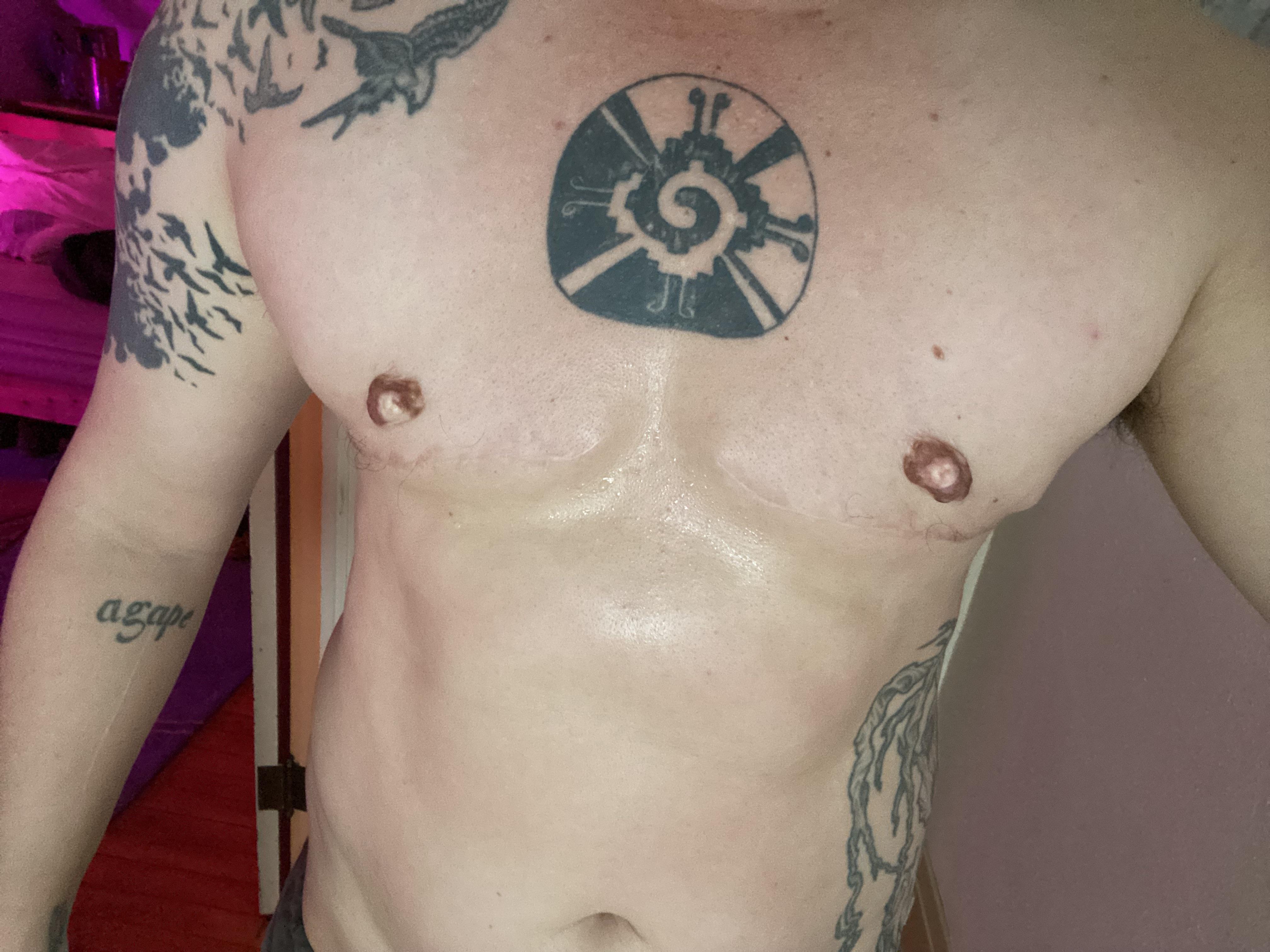 14 months post DI / 1 year post being cleared for exercise. Dr Sun T Hsieh at U of MN