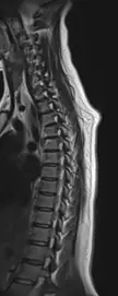 Neck pain MRI