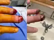 Repair of a traumatic partial finger amputation. Same day and 3 weeks later