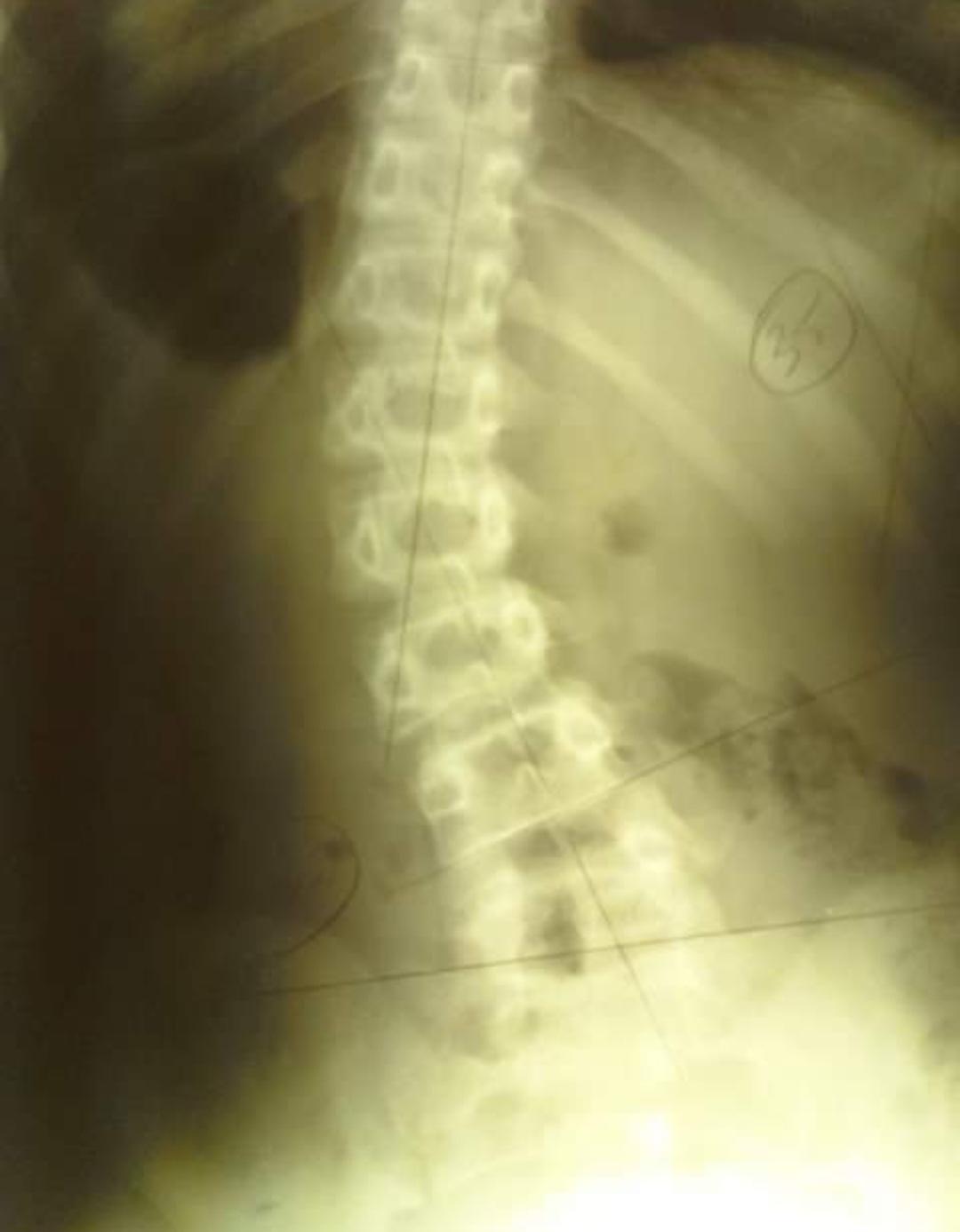 Scoliosis repair x-ray showing spinal rods and screws for deformity correction
