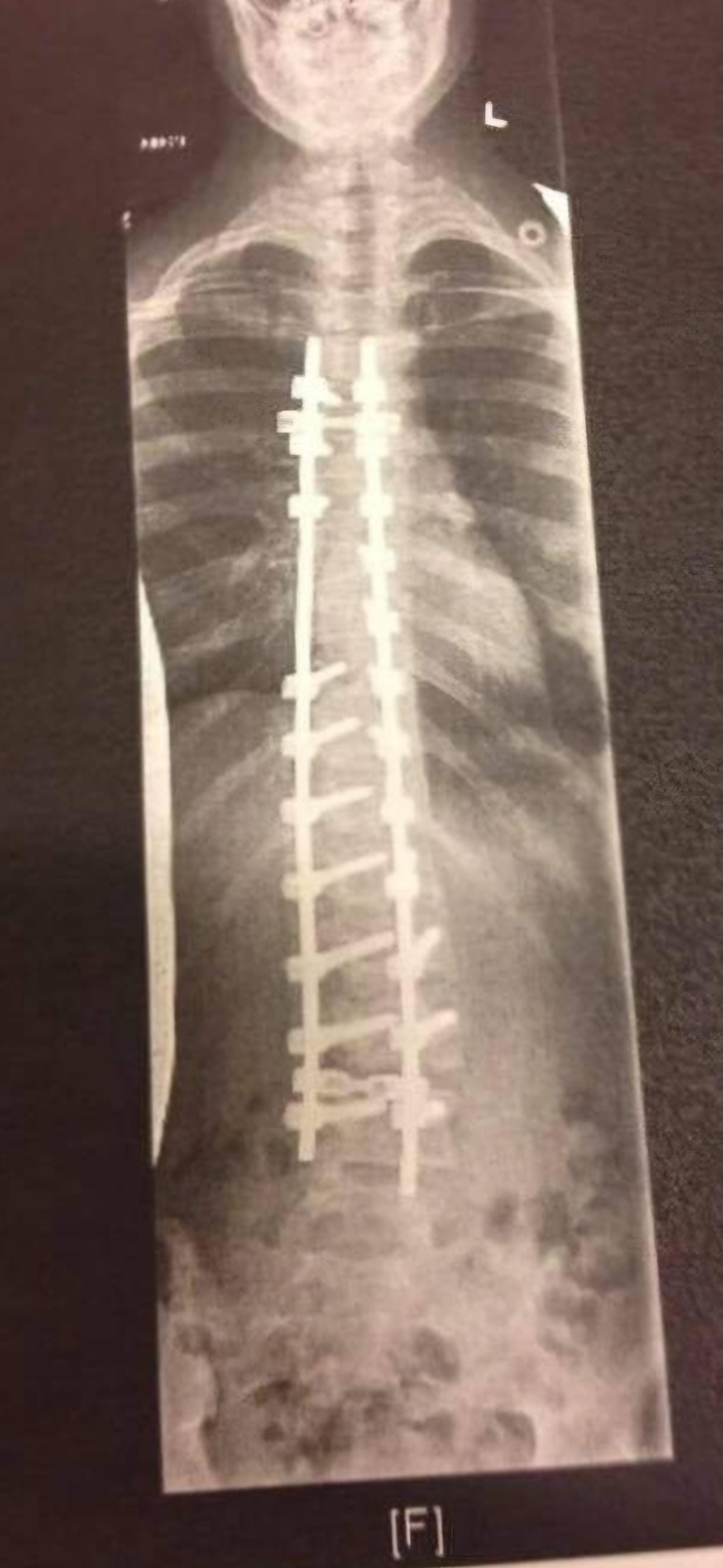 Scoliosis repair x-ray showing spinal rods and screws for deformity correction