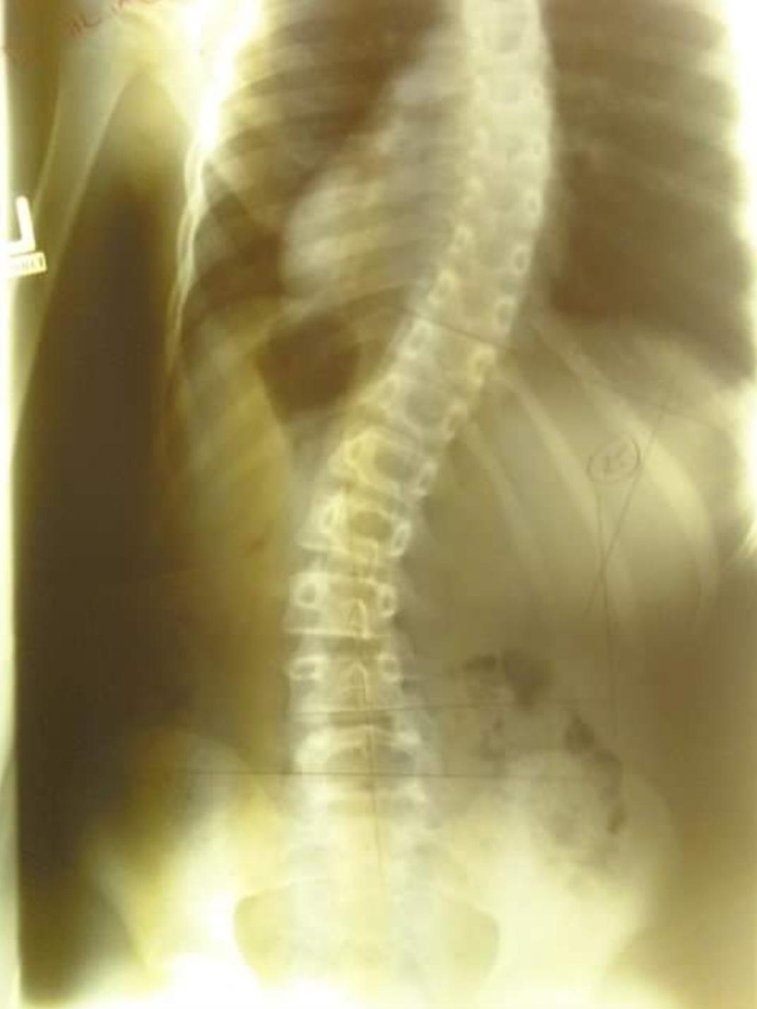 Scoliosis repair and complication