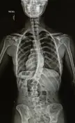 X-Ray of my spine that is curved from Scoliosis