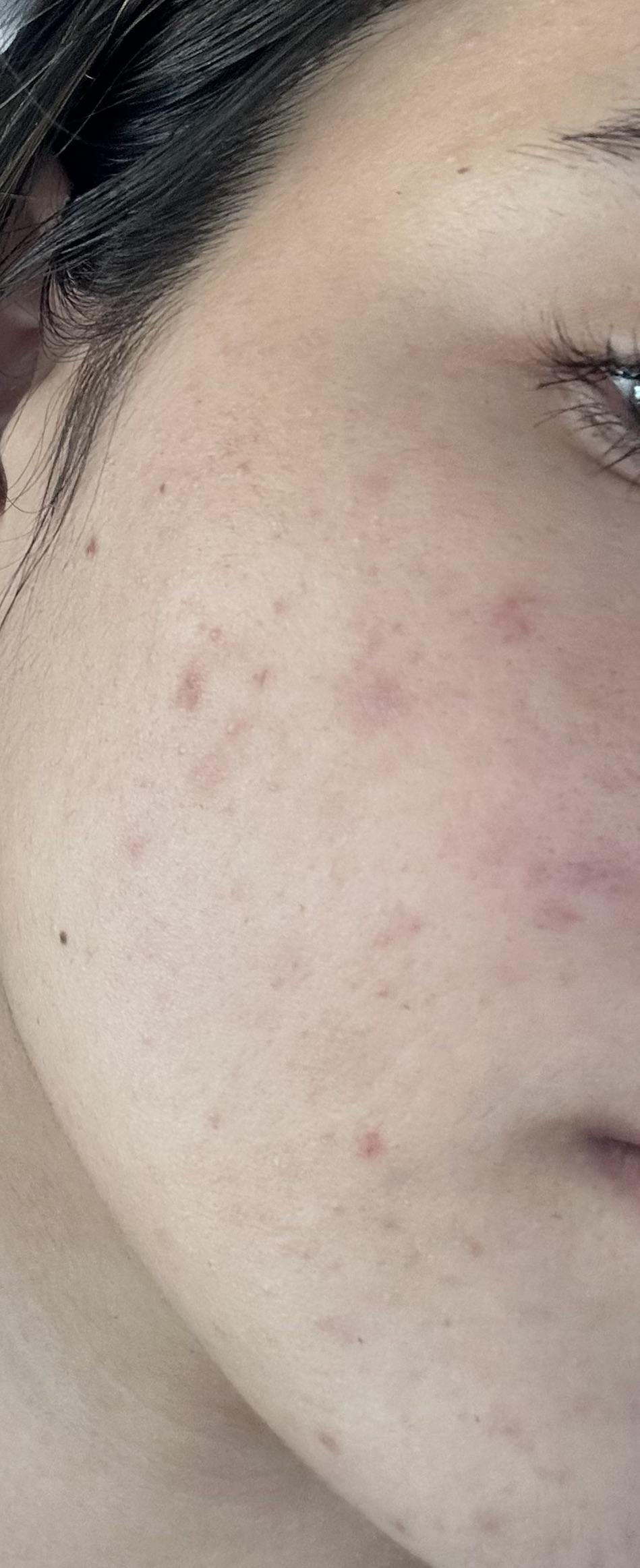 Spots Post How to get rid of dark spots/post acne marks??! | Scrolller