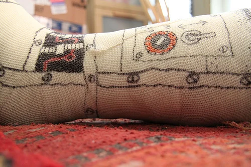 Broken ankle: Cast detail